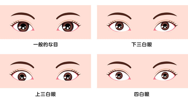 三白眼には主に3つの種類がある